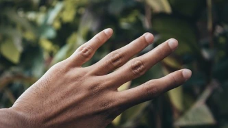 Mycoses des ongles