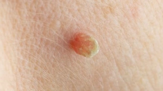 Acrochordon