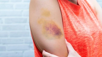 Bleus, bosses, hématomes