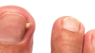 Ongle incarné