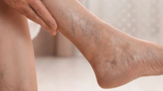 Varices