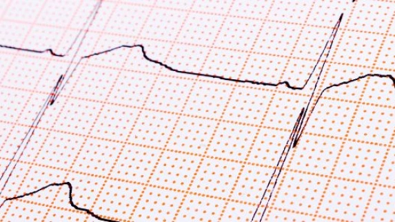 Troubles du rythme cardiaque