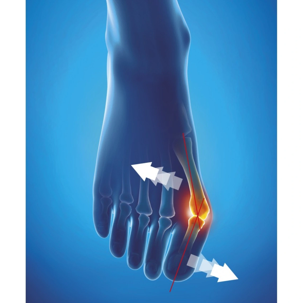 Epitact Hallux Valgus Orthèse Corrective de Nuit - Vue 5