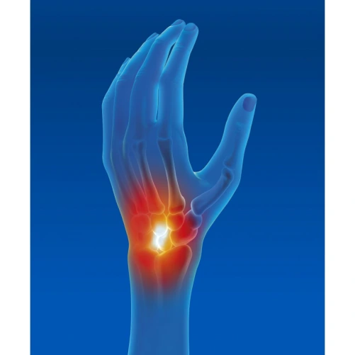 Epitact Attelle Poignet d'Immobilisation