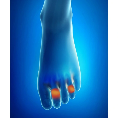 Epitact Barrette Sous Diaphysaire