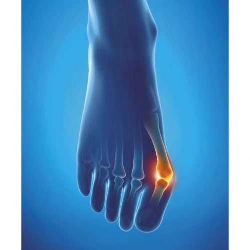 Epitact Écarteurs à l'Epithélium