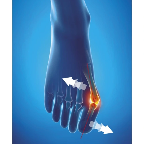 Epitact Hallux Valgus Orthèse Corrective de Nuit