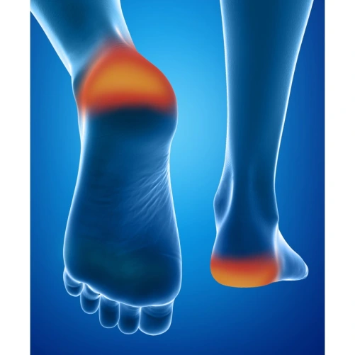 Epitact Protections Anti-Crevasses