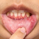 Aphte, soins spécifiques