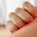 Irritations, Rougeurs, Eczéma