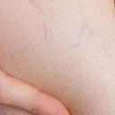 Jambes lourdes, Varices