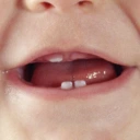 Petits maux, Premières dents