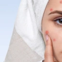 Traitement de l'acné