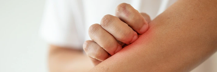 Irritations, Rougeurs, Eczéma